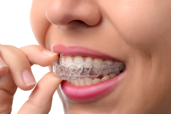 Things To Know Before Getting Invisalign