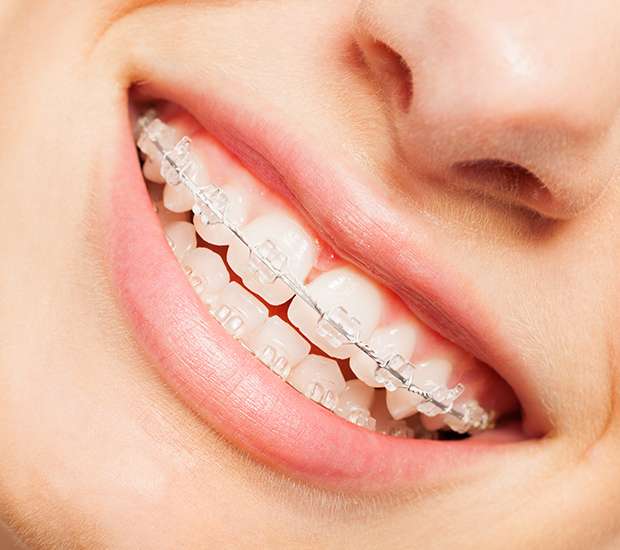 Fair Oaks Clear Braces