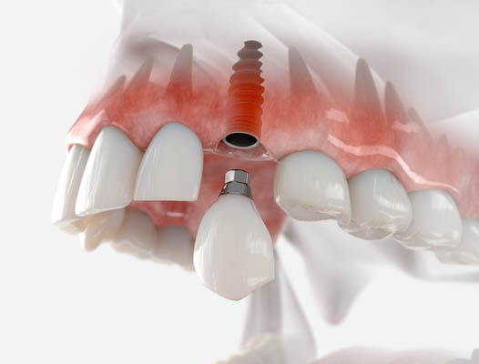 Dental Implant Fair Oaks, CA