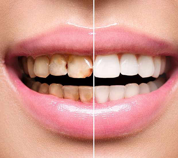 Fair Oaks Dental Implant Restoration