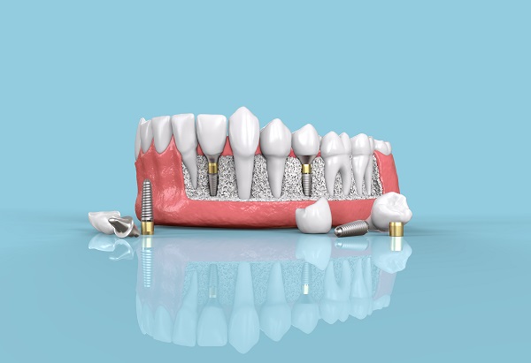 Dental Implants Fair Oaks, CA
