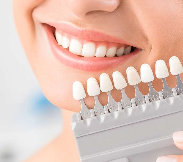 Fair Oaks Dental Veneers and Dental Laminates
