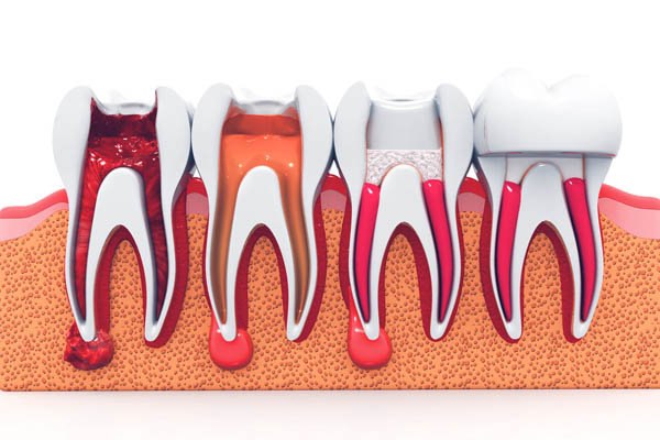 Why A Root Canal Treatment Is Done